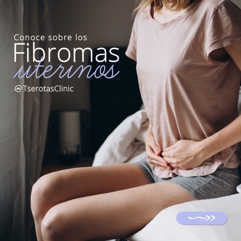 Conoce sobre los fibromas uterinos